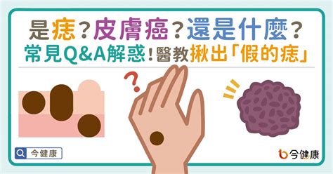 腋下長痣|是痣？皮膚癌？還是什麼？常見Q&A解惑！醫教揪出「。